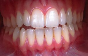 Occlusion dentaire : causes, symptômes et traitements efficaces