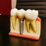 Prix Implants Dentaires