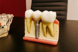 Prix Implants Dentaires
