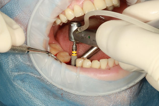 Implants Dentaires Low Cost
