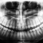radiographie panoramique dentaire montrant les dents de sagesse