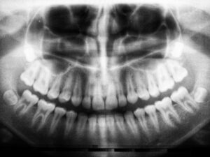 radiographie panoramique dentaire montrant les dents de sagesse
