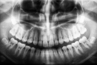 radiographie panoramique dentaire montrant les dents de sagesse